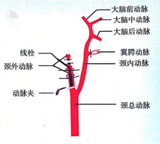 分离颈总动脉 分离颈总动脉