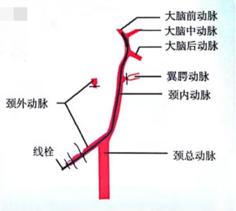 颈外动脉插入颈内动脉 颈外动脉插入颈内动脉