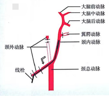 双线结扎颈外动脉 双线结扎颈外动脉