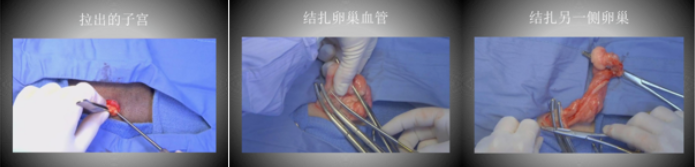 子宫结扎 子宫结扎