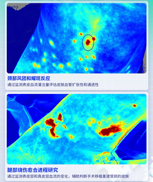 必威官方首页官网betway激光散斑血流成像系统获批FDA认证