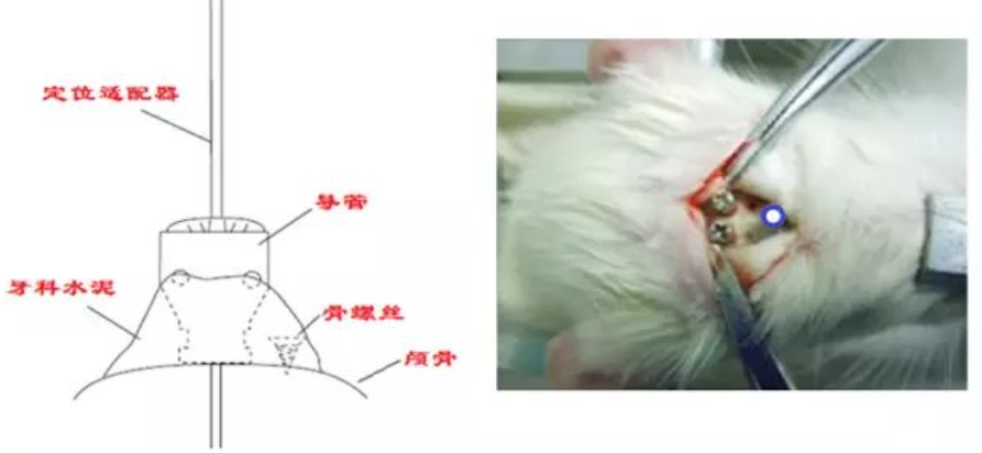 植入探针导管